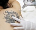 Xóa hình xăm bằng laser như thế nào