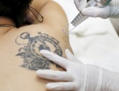 Xóa hình xăm bằng laser như thế nào