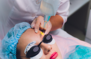 Có nên xóa xăm chân mày bằng laser