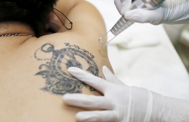 Xóa hình xăm bằng laser như thế nào